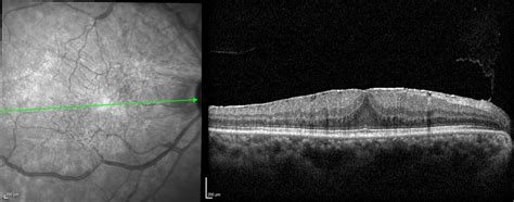 Epiretinal membrane (macular pucker) | Macular Disease Foundation