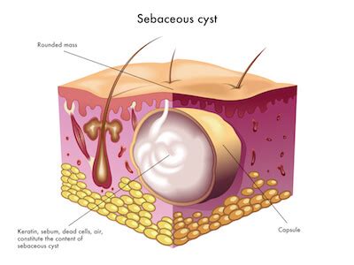 Sebaceous Cyst Removal Singapore | 3 Reasons To Pay Attention