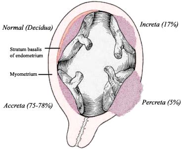 Placenta accreta — Wikipédia