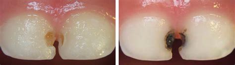 Massachusetts Medical Society: Silver Diamine Fluoride: Treatment for Cavities May Explain Black ...