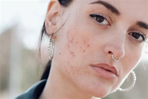 This Acne Face Map Will Help You Understand What The Placement Of Your Pimple Means