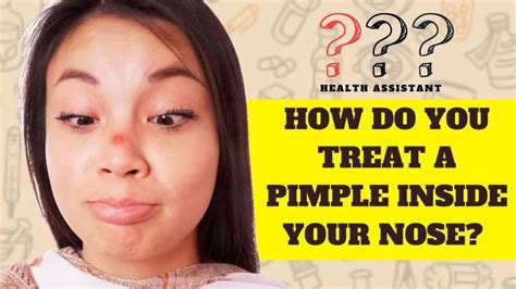 How Do You Treat A Pimple Inside Your Nose? |What Causes Inner Nose Pimples? in 2022 | Nose ...