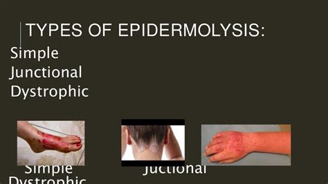 Epidermolysis bullosa