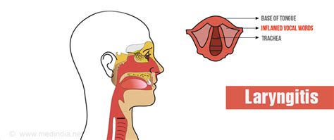 Laryngitis - Causes, Symptoms, Diagnosis, Treatment