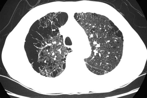 Emphysema Threshold on CT Imaging May Have Predictive Value for COPD ...