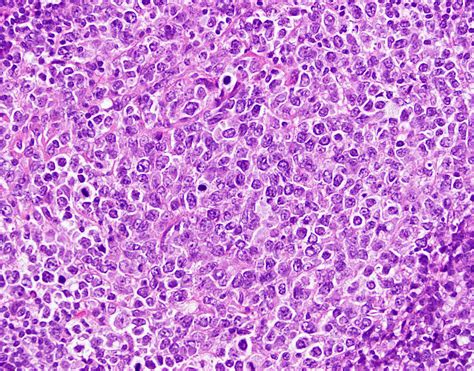 Follicular Lymphoma Pathology Outlines