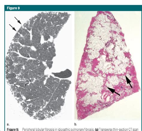 Thin-section CT of the secondary pulmonary lobule: anatomy and the ...