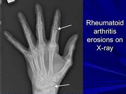 Hand Arthritis Treatment with Cold Laser