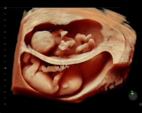 Pin by Multiples and More on Random | 3d ultrasound, Twins ultrasound, Ultrasound reveal