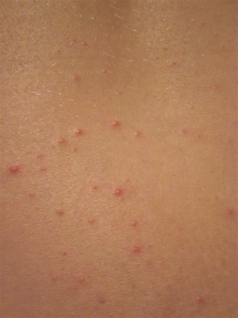 pimple like rash for 2 1/2 weeks