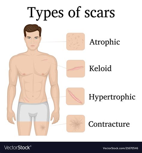 Types of scars Royalty Free Vector Image - VectorStock