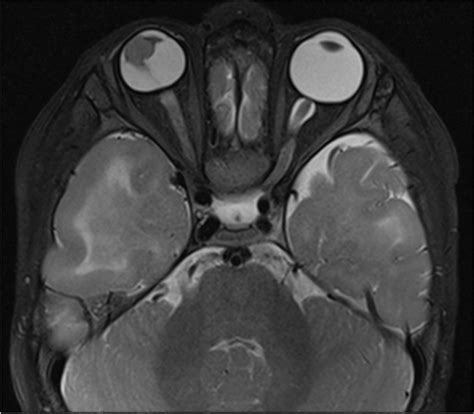 MRI orbits axial T2 and sagittal post-contrast T1 sequences demonstrate... | Download Scientific ...