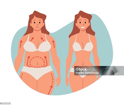 Womans Body Before And After Plastic Surgery Flat Style Stock ...