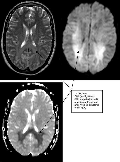 Hypoxic-ischaemic brain injury | Practical Neurology