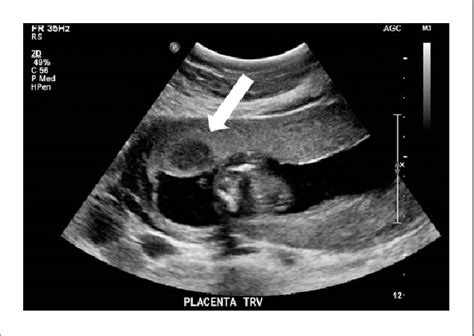 Figure 1 from Sonographic Evaluation of a Large Placental Chorangioma ...