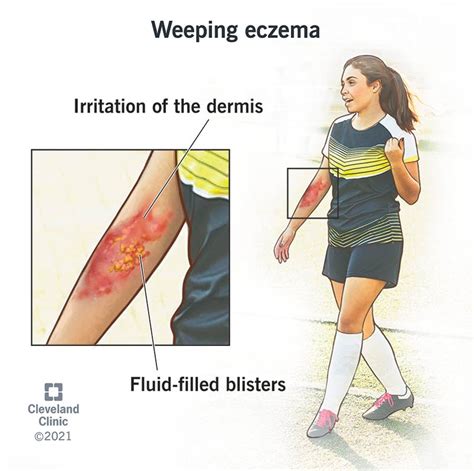 Weeping Eczema: Symptoms, Causes, Treatment & Care