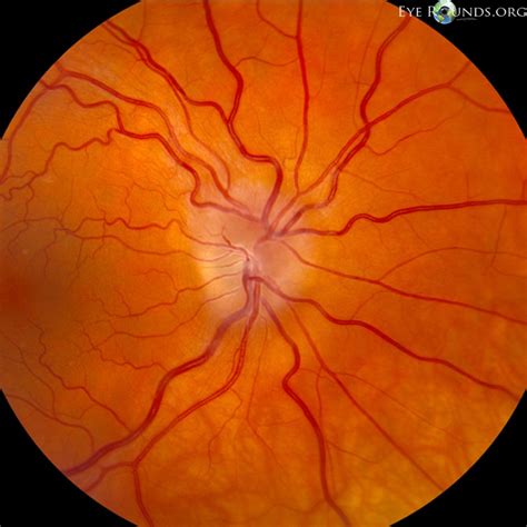 Atlas Entry - Optic nerve sheath meningioma