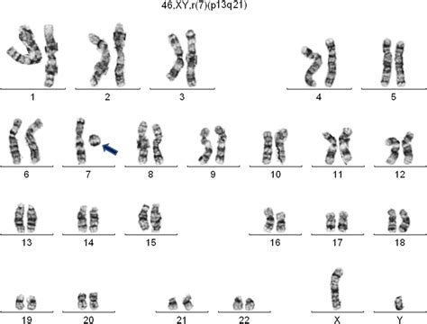 Ring chromosome with deletion 7q in acute myeloid leukaemia | BMJ Case Reports