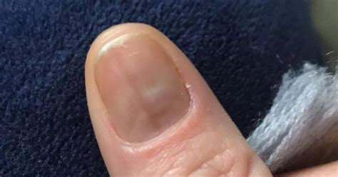 Scots mum's 'bruise' under fingernail turned out to be rare skin cancer ...