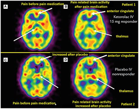 Frontiers | Utility of SPECT Functional Neuroimaging of Pain