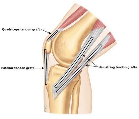 ACL Reconstruction: Graft Choices: Colorado Sports Medicine & Orthopaedics: Orthopaedics