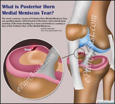 Pin on Sports Injuries