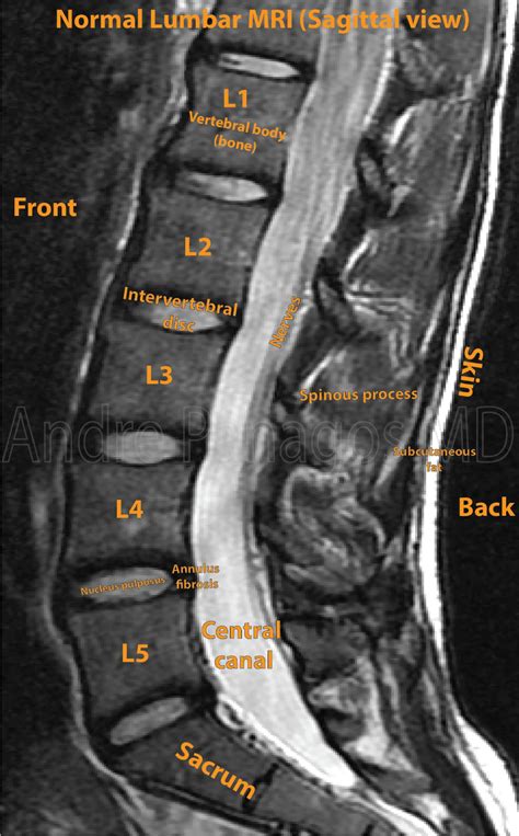 Healthcare Extreme How To Read An MRI Lumbar Spine In 8 Easy Steps | Mri, Lumbar, Lumbar disc