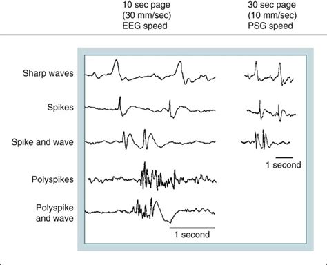 Clinical Electroencephalography and Nocturnal Epilepsy | Neupsy Key