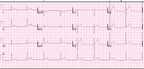 Dr. Smith's ECG Blog: July 2013