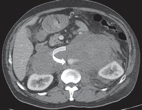 Cross-sectional Imaging Features of Primary Retroperitoneal Tumors and ...