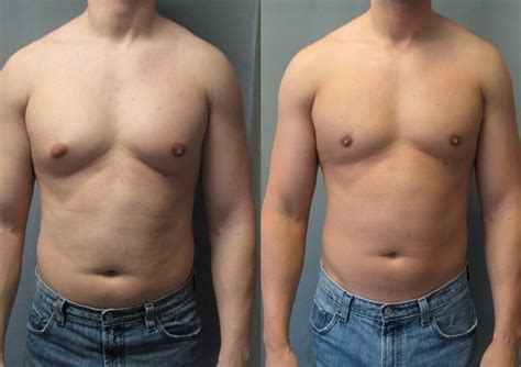 What Is Gynecomastia and How To Deal With It | Cuidadoalzheimer.com