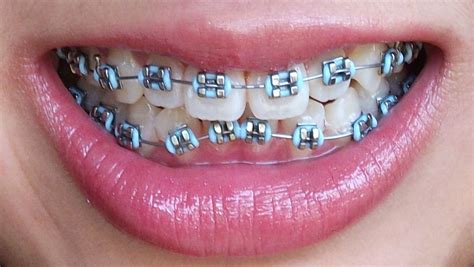 Coastal Orthodontic Care, Dr. Adam G. Lautt, 805-650-1080 | Teeth braces, Braces bands, Braces ...