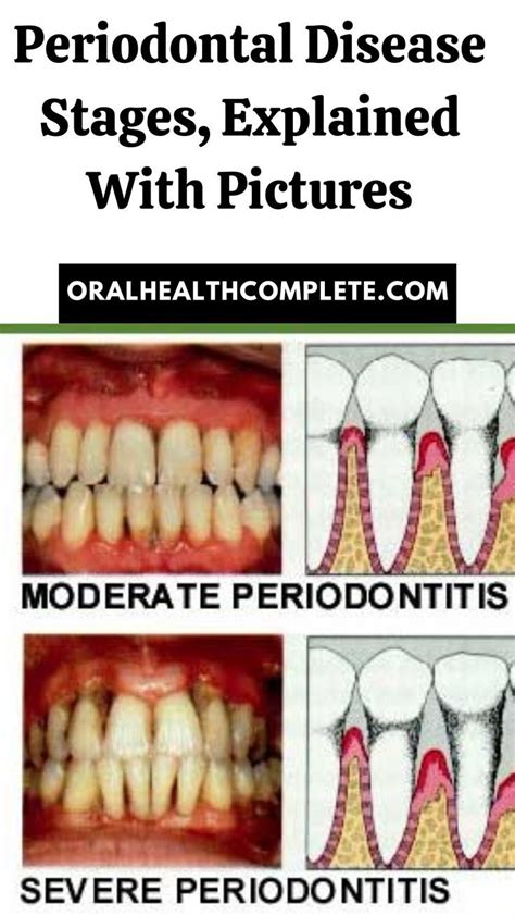 Periodontal Disease Stages, Explained With Pictures