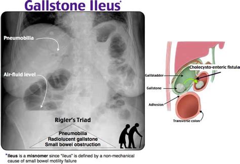 GALLSTONE ILEUS - New