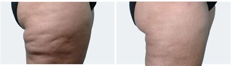 Cellulite Treatment with Endermologie by Courthouse Clinics