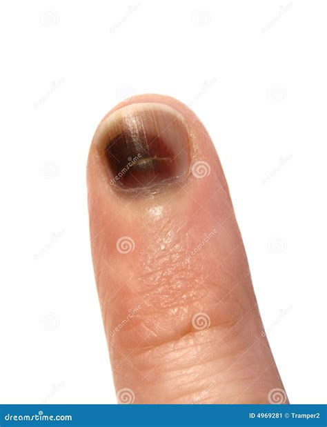 Bruise stock image. Image of hand, finger, bled, hack - 4969281