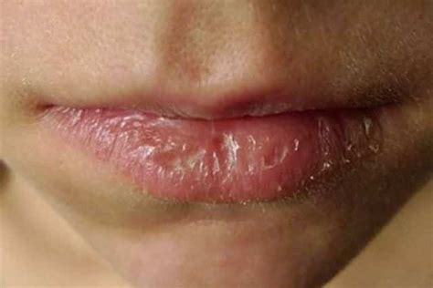 Dry Patches on Lip, Upper, Lower, Pictures, Causes, Not Cold Sore ...