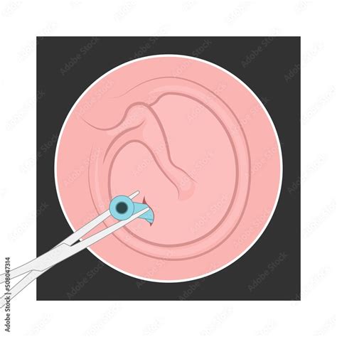 Perforated eardrum tube surgical drain Otitis media ear wax Hole repair sound canal tear pain ...