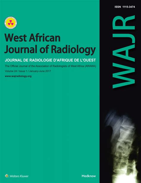 [PDF] Vertebrobasilar dolichoectasia