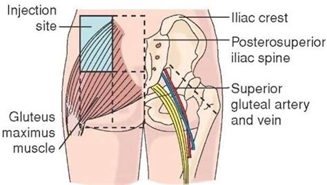 Penicillin Injection Site