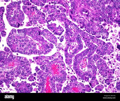 Serous carcinoma, light micrograph Stock Photo - Alamy