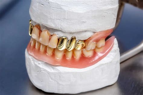 Permanent Gold Teeth - Online Dental Care