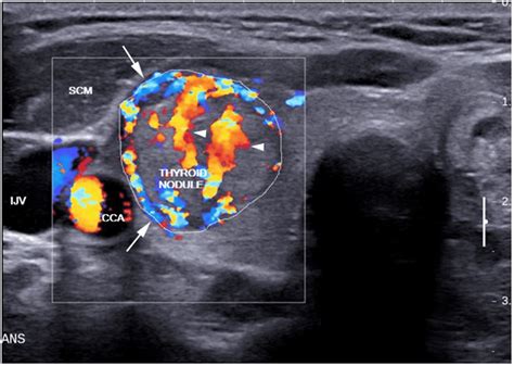 Transverse color Doppler sonogram of a nodule in the right thyroid lobe ...