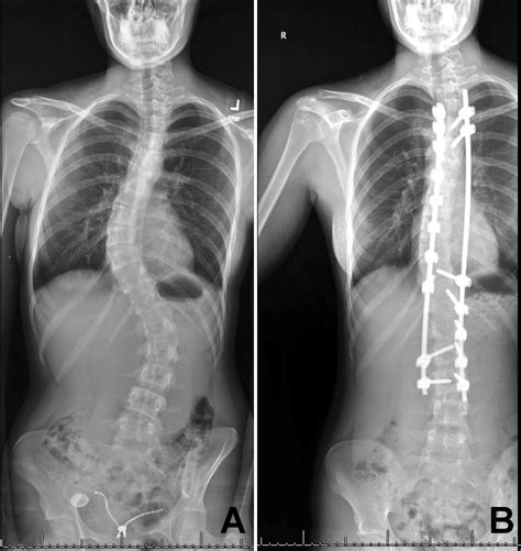 Scoliosis is Not a Disease