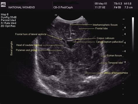 Cranial ultrasound: a guideline for the performance of routine cranial USS for preterm infants