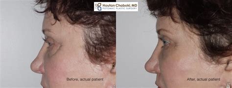 Botox vs. Fillers in Liquid Facelift – Potomac Plastic Surgery