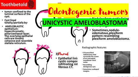 Unicystic ameloblastoma | Odontogenic tumors Oral pathology ...