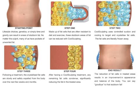 Cryolipolysis | Norfolk Body Clinic