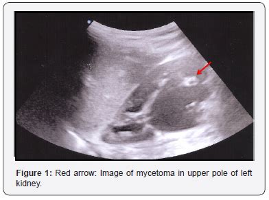 Mycetoma Ultrasound