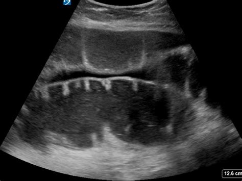 Bowel obstruction - Critical Care Sonography